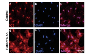 靶向ACSL4調控的星形膠質細胞鐵死亡：揭示與緩解視神經脊髓炎譜系障礙神經炎癥的新機制